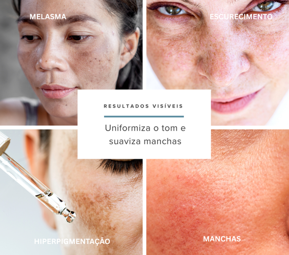 Kit Melasma e Manchas
